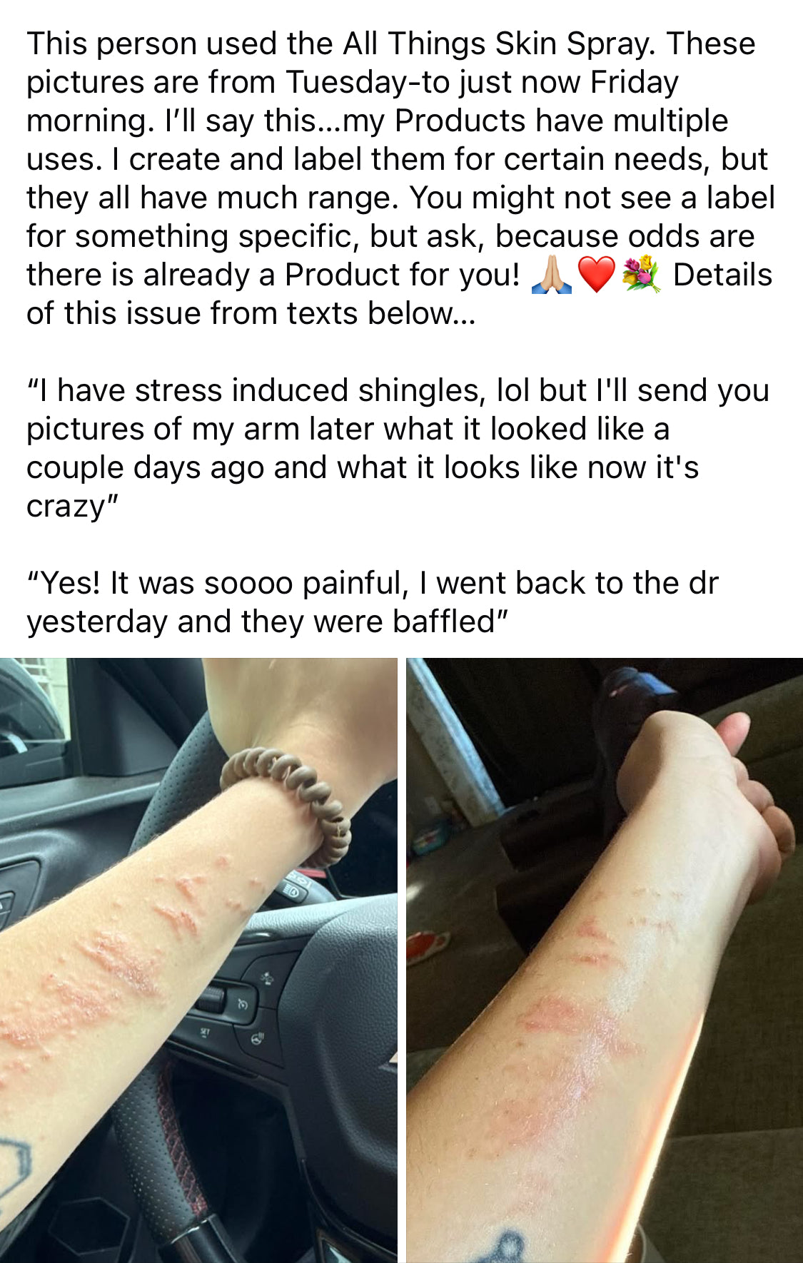 Text message with product review and images of a person's arm with redness and healing.
