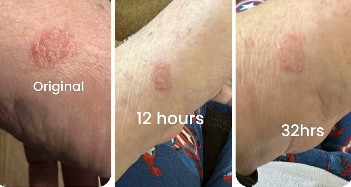 Before and after comparison of a skin condition on a person's leg over 32 hours.