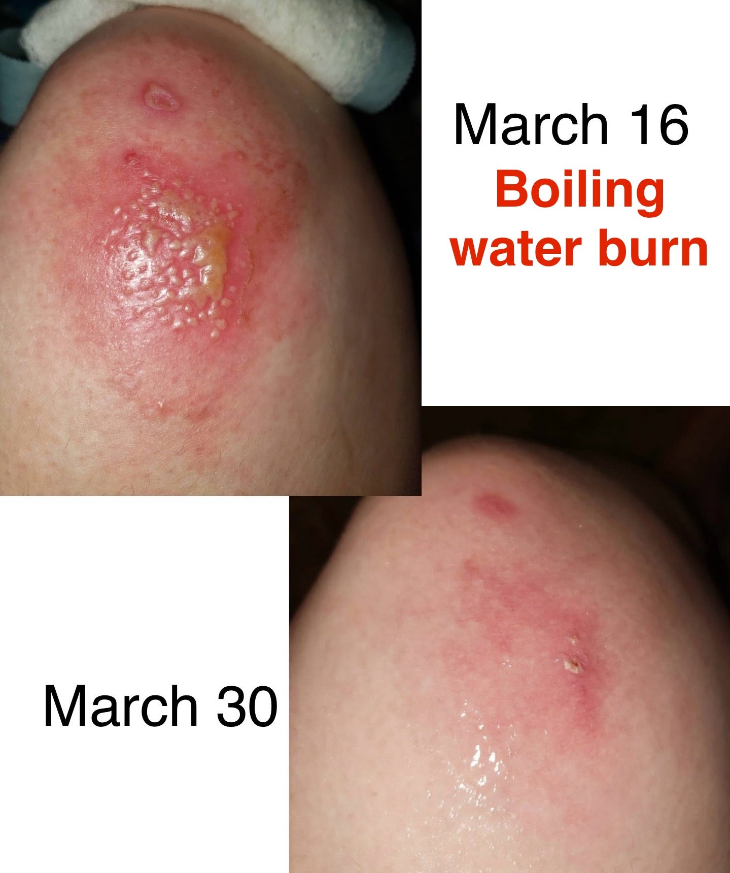 Before and after comparison of a boiling water burn on March 16 and March 30.