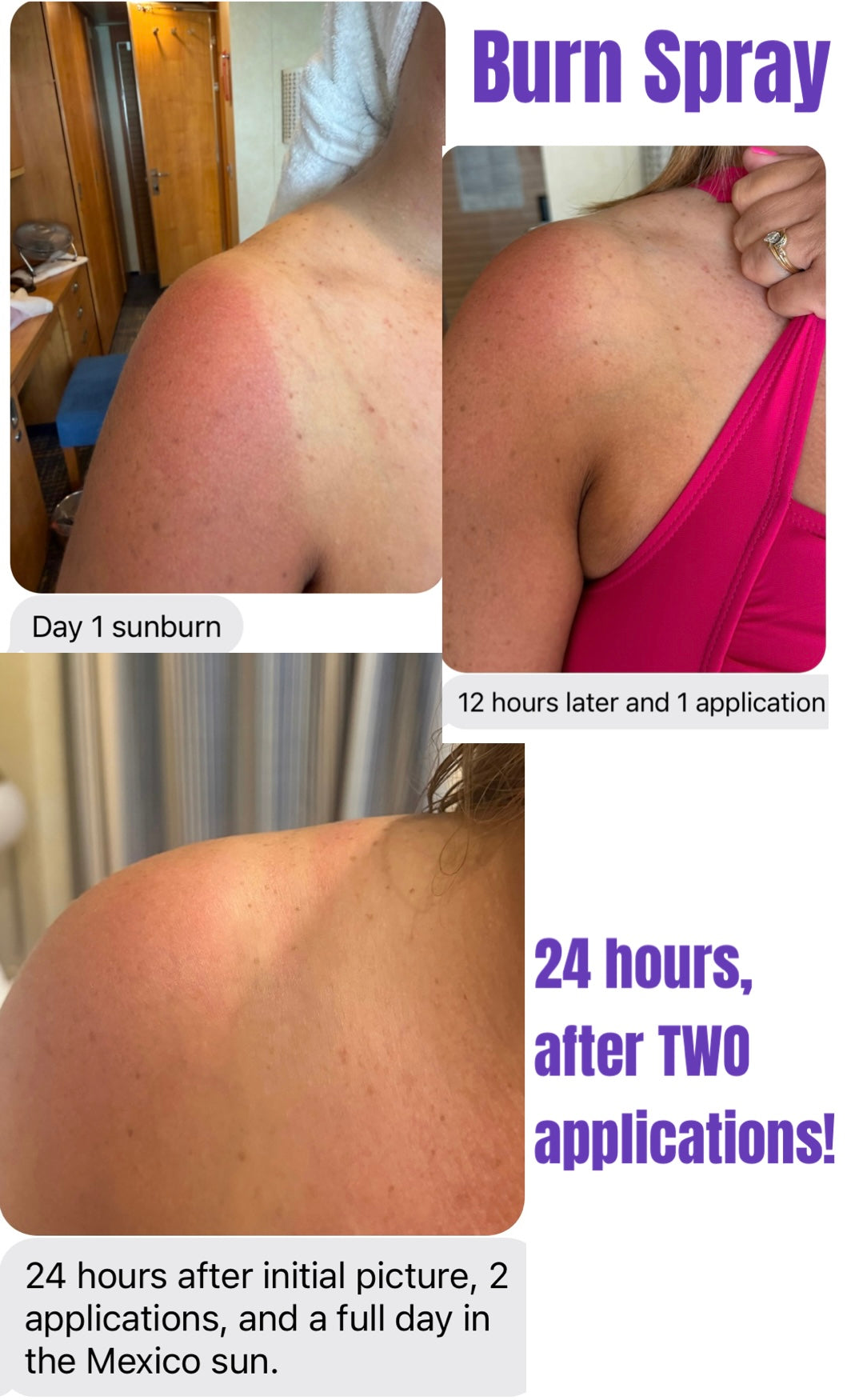 Before and after showing sunburn treatment with 'Burn Spray' over 24 hours.