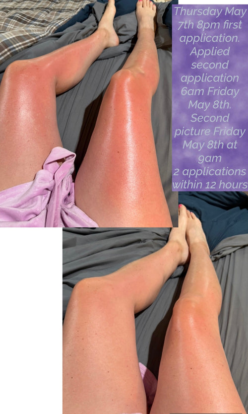Two images of legs before and after burn spray. 
